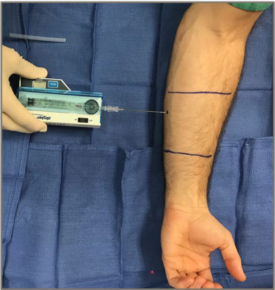 SÍNDROME COMPARTIMENTAL